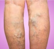 Varicose Veins