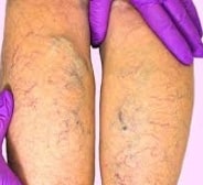 Venous Insufficiency